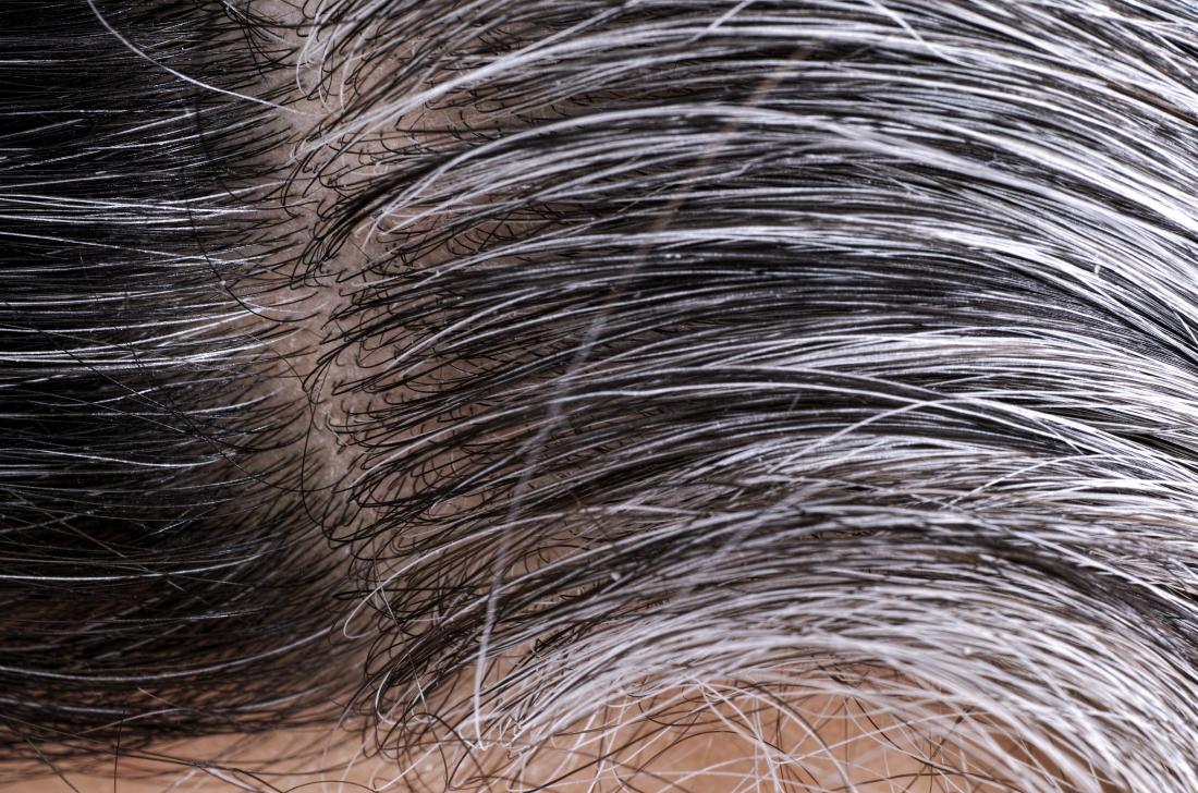 Gray Hair Can Return to Its Original Colorand Stress Is Involved of  Course  Scientific American