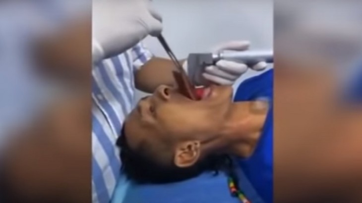 doctor removes a 7 inch long fish from fisherman throat in columbia