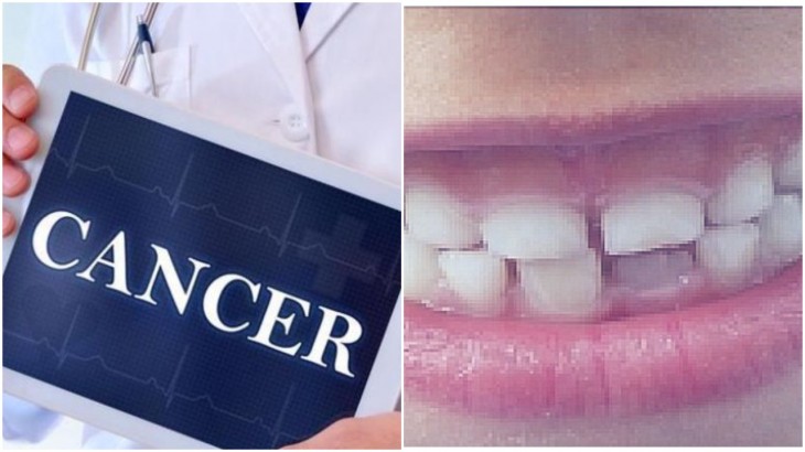 Oral Health Day-Tongue Cancer