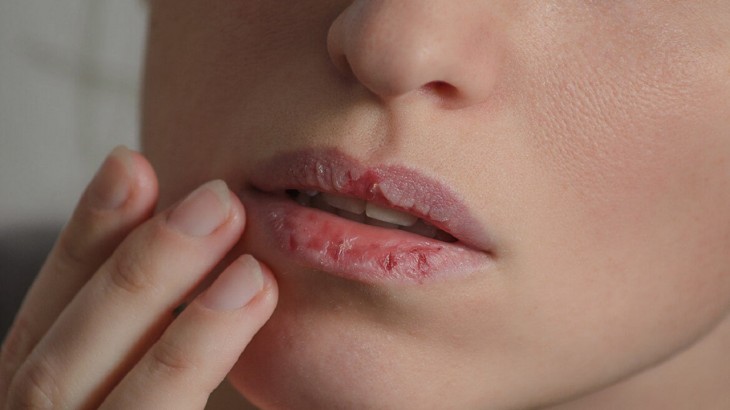 CHAPPED LIPS TREATMENT AND CAUSES