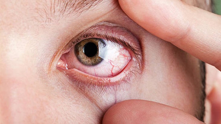 signs of high cholesterol in eyes