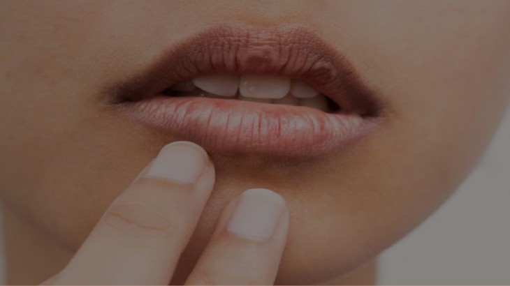 Black lips causes