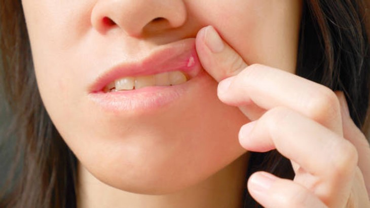 Mouth Ulcer Home Remedies