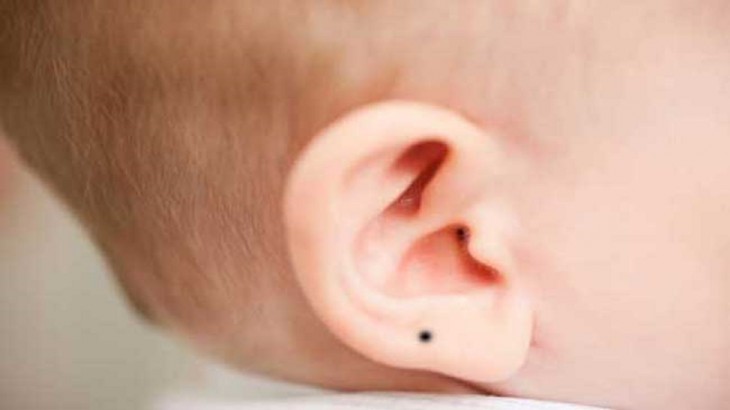 Ear Mole Meaning