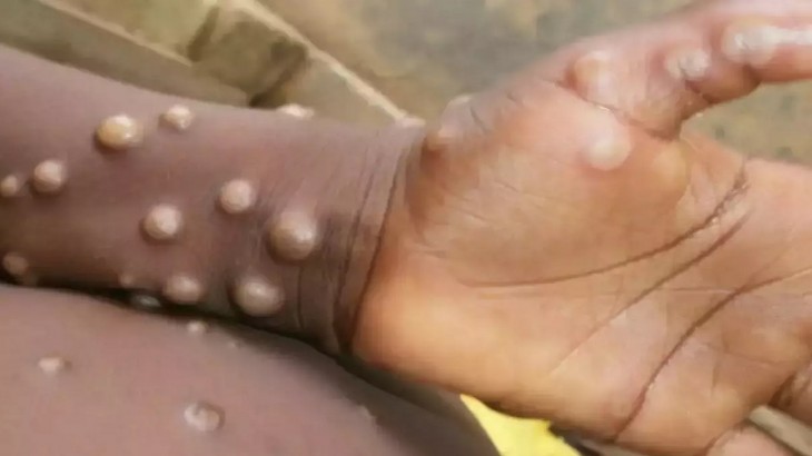 Monkeypox Symptoms