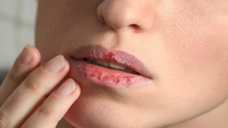 How do you fix cracked lips in the winter?
