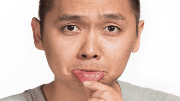 Mouth Ulcers Remedies