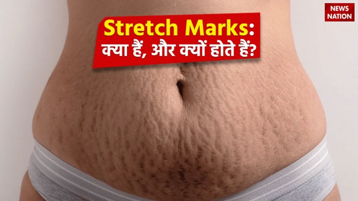 What are stretch marks and why do they occur Know home remedies to reduce it