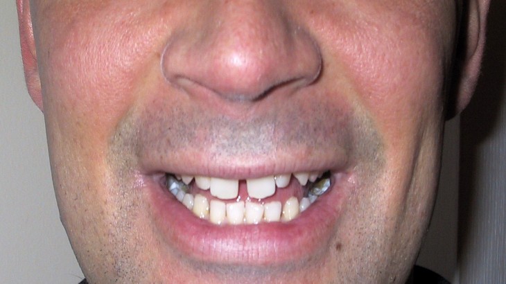 gap between teeth