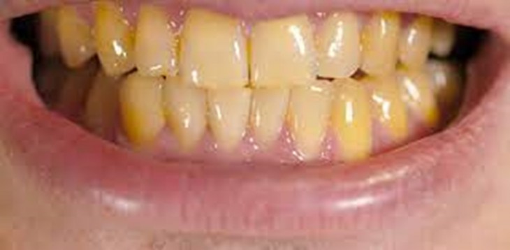 yellow teeth how to reduce it remedies