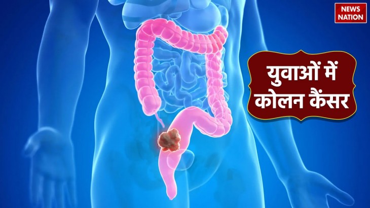 Colon cancer in Younger People symptoms reasons and treatment