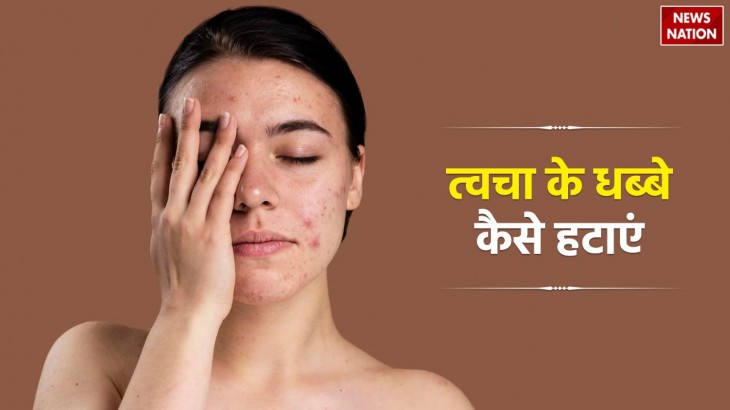 How to Remove Skin Spots naturally