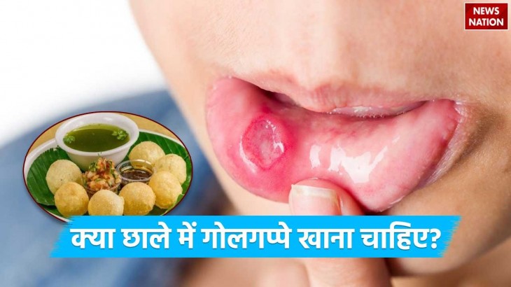 Can eating golgappas cure mouth ulcer